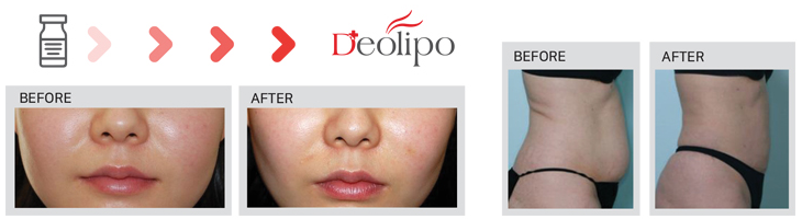 Deolipo